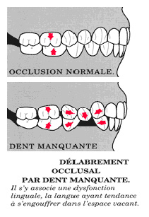 Délabrement occlusal par dent manquante